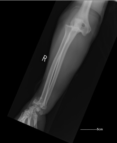Dislocated Elbow Fracture wrist